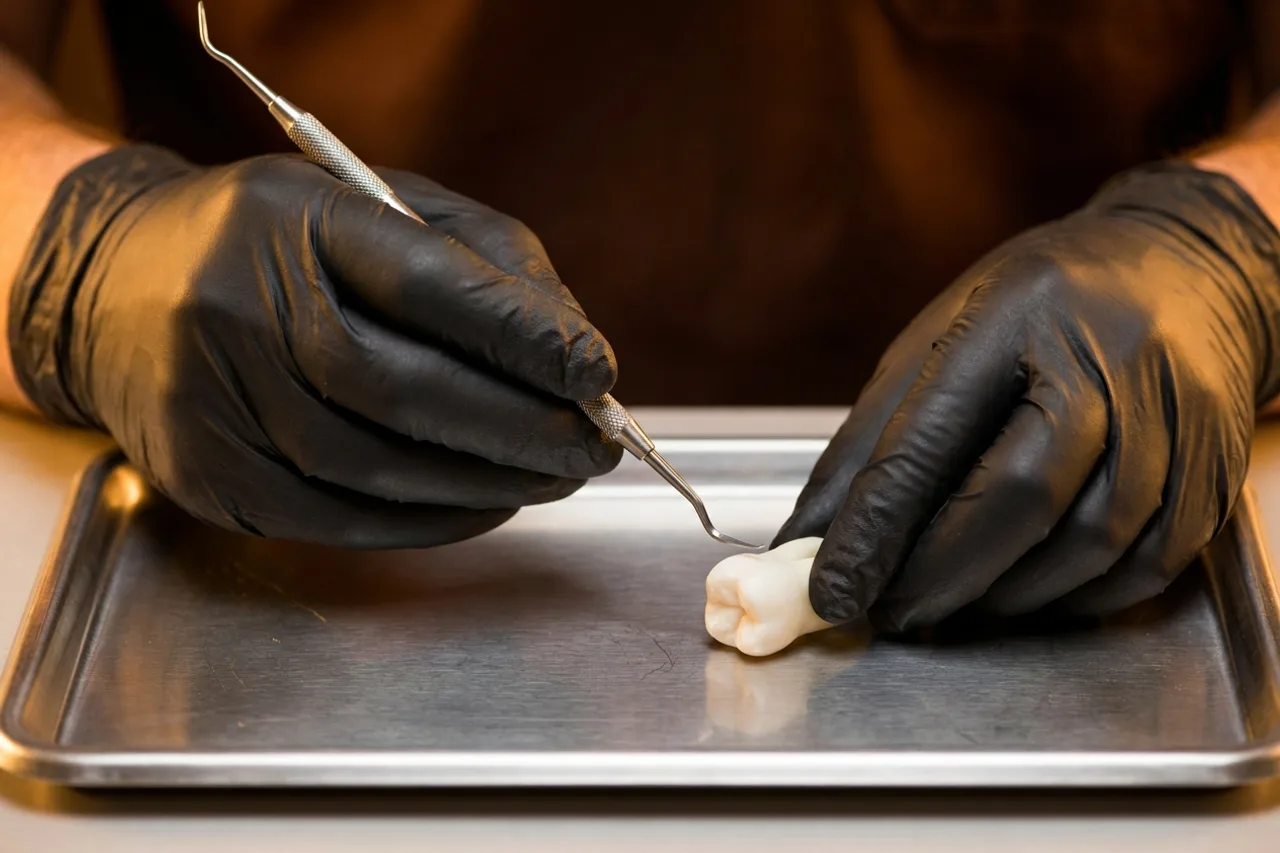 Biofilme dental, placa bacteriana e tártaro: qual a diferença
