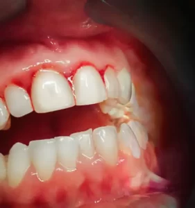 Sangramento na gengiva — sinal de gengivite e inflamação gengival