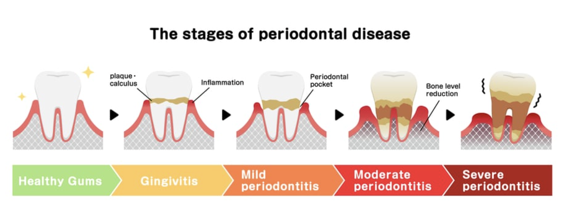 Estágios da doença periodontal: gengiva saudável, gengivite, periodontite leve, moderada e severa