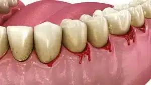 Gengiva sangrando — sinal de inflamação ou gengivite