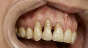 perda óssea nos dentes